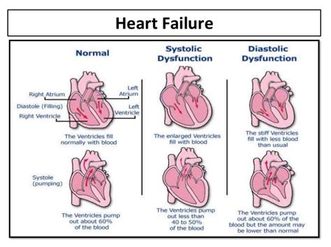 acute lv failure|stages of left ventricular failure.